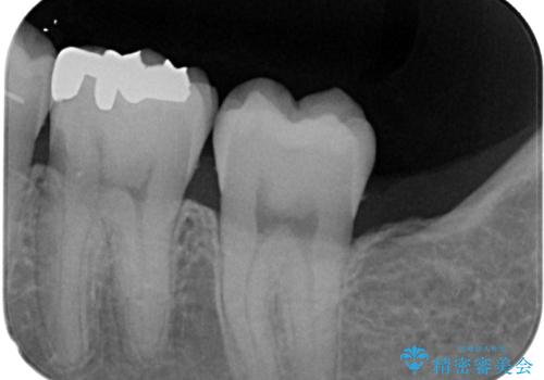セラミックに取り替えたい セラミックインレー修復の治療前