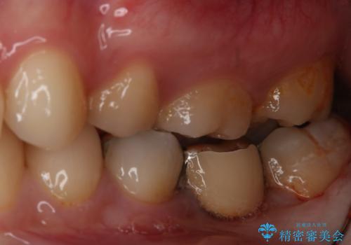 銀歯をやり変えたい フルジルコニアブリッジの治療前