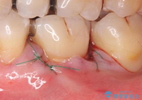 歯肉退縮に対する結合組織移植の治療中