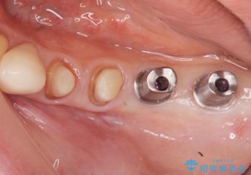 [ 不適合な補綴物による虫歯の再発 ]  劣化の進んだブリッジの再治療の治療中