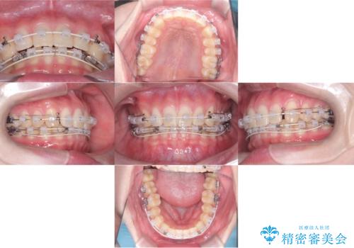 【ワイヤー矯正】すきっ歯を治したいの治療中