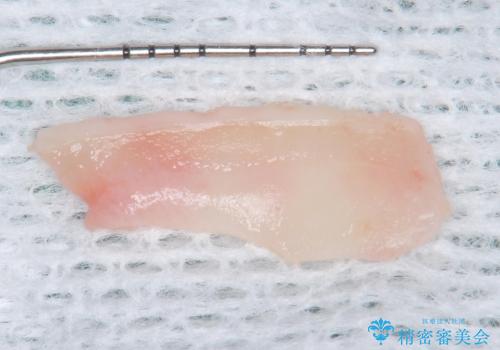 歯肉退縮に対する結合組織移植の治療後