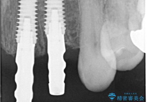 歯茎の腫れが気になる方必見!|抜歯即時インプラントで前歯5本を痛みなく3か月で治療完了!の治療中
