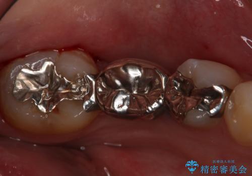 銀歯をやり変えたい フルジルコニアブリッジの治療前
