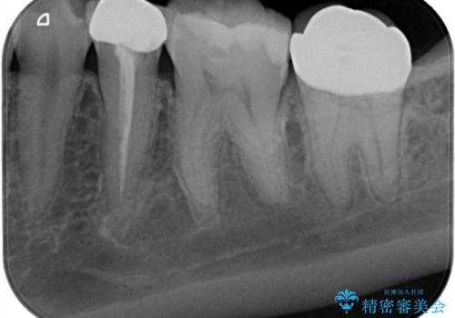 奥歯に虫歯があると言われた　セラミッククラウンでキレイで長持ちする歯への治療後