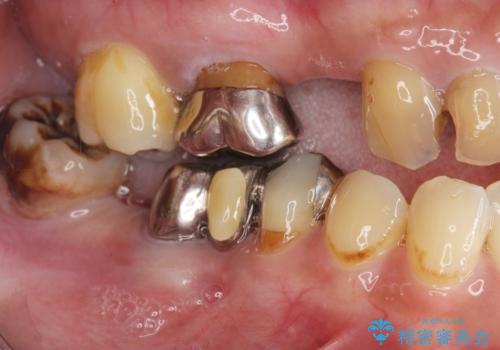 長期的な予後を見据えたインプラント治療の症例 治療前