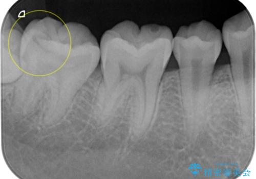 虫歯治療後、精度の良いゴールドアンレーへ