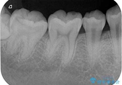 虫歯治療後、精度の良いゴールドアンレーへの治療前