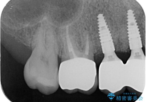 長期的な予後を見据えたインプラント治療の治療後