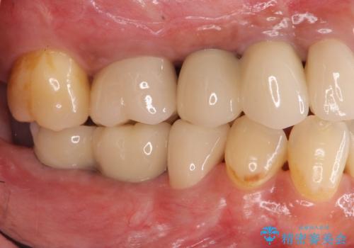 長期的な予後を見据えたインプラント治療の症例 治療後