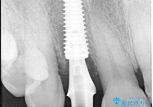 前歯の隙間とへこみが舌で触ると気になる|矯正治療は絶対にしたくない|抜歯即時インプラント+オールセラミッククラウンで審美修復の治療中