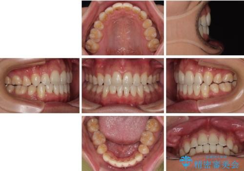 【モニター】前歯のデコボコと口元の出っ張りを改善!目立たない矯正で自然な笑顔にの治療後