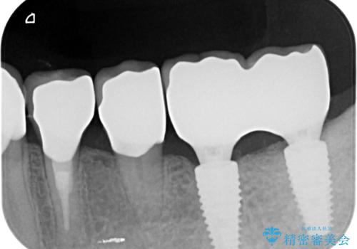 [ 不適合な補綴物による虫歯の再発 ]  劣化の進んだブリッジの再治療