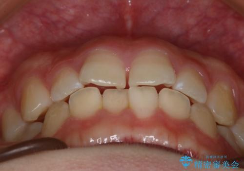 前歯のガタつきを治したい インビザライン・ライトパッケージの治療前