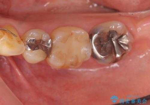 銀歯の下で虫歯の再発 拡大鏡下で行う虫歯の精密治療の症例 治療前