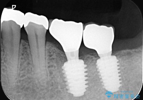 合わない入れ歯から卒業!奥歯2本をインプラントで快適にの治療後