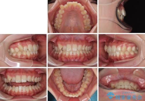 マウスピース矯正が煩わしい ワイヤー装置での非抜歯矯正の治療前