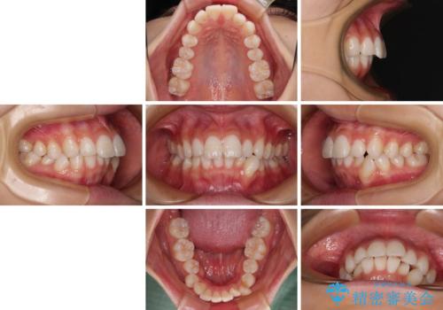 斜め前に飛び出した前歯 抜歯矯正で素敵な横顔にの治療前