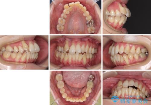 急速拡大装置 狭い骨幅を拡大した上で、顕著なデコボコを改善する抜歯矯正治療の治療前