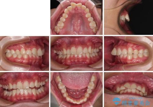 デコボコをインビザライン矯正で改善 奥歯は補助装置で確実に移動をの治療前