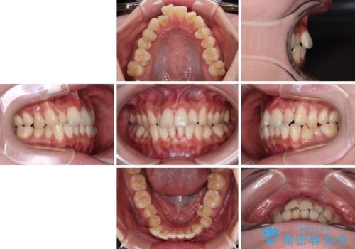 急速拡大装置 狭い歯列を拡大してクロスバイトを短期間矯正治療の治療前