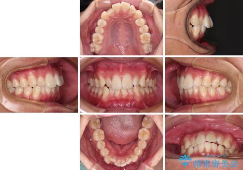 前歯のデコボコをインビザラインで綺麗に改善の治療前