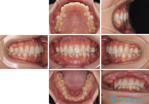 デコボコの非抜歯矯正 ワイヤー装置で楽して改善の治療前