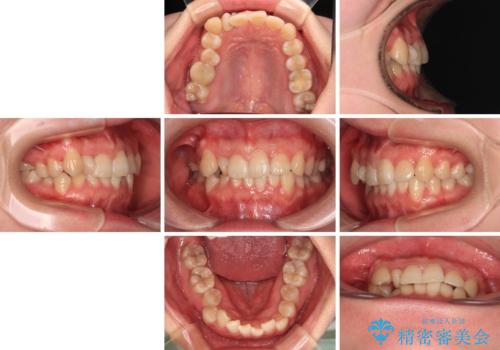 捻転の強い前歯 ワイヤー装置での非抜歯矯正の治療前