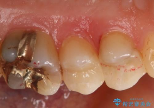 銀歯を白くしたい セラミックインレーの治療後