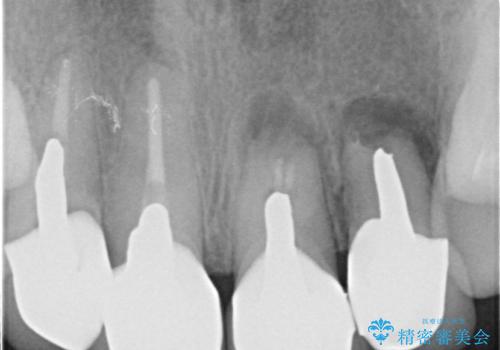 歯槽堤保存術を併用したブリッジ治療の治療前