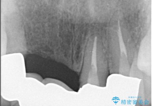 歯茎の腫れが気になる方必見!|抜歯即時インプラントで前歯5本を痛みなく3か月で治療完了!の治療前