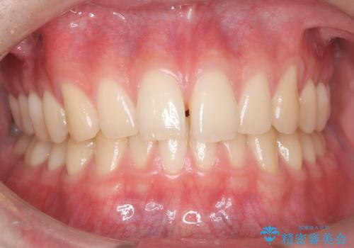 【ワイヤー矯正】すきっ歯を治したいの治療前