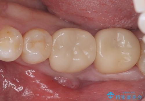 【歯牙移植】奥歯抜歯と言われたので親知らずを移植してほしいの治療前