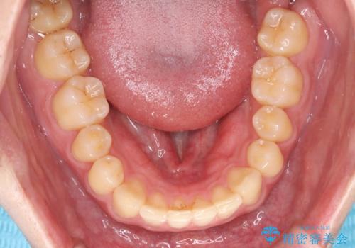 【ワイヤー矯正】すきっ歯を治したいの治療後