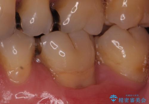 歯肉退縮に対する結合組織移植の症例 治療後