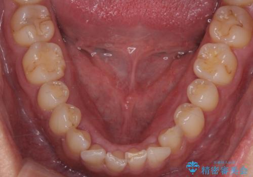 骨隆起を取りたいの治療後