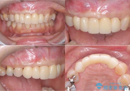 歯茎の腫れが気になる方必見!|抜歯即時インプラントで前歯5本を痛みなく3か月で治療完了!の治療後