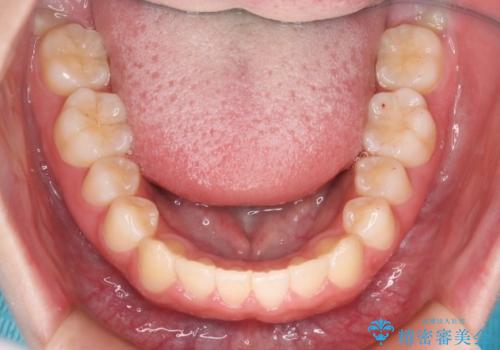 前歯のガタつきを治したい インビザライン・ライトパッケージの治療後