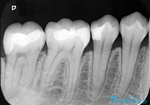 奥歯の銀歯を自然に!右下6番のメタルフリー治療の治療後