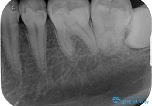 左下に虫歯が見つかった セラミックインレー修復の治療前