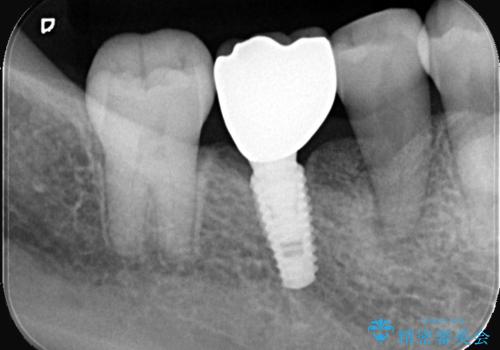 歯周病治療、部分矯正、インプラントを組み合わせた奥歯の治療の治療後
