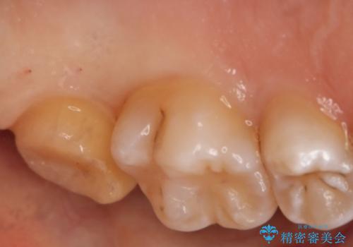 奥歯を治療したい　フルジルコニアクラウンの治療中
