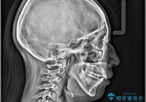 軽度の歯のデコボコ(叢生)をインビザライン(マウスピース)で改善|わずか5か月で整った歯並びにの治療前