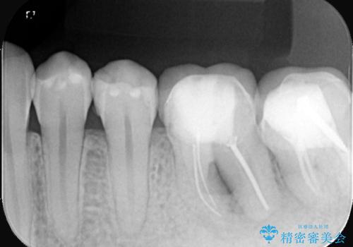 【歯牙移植】奥歯抜歯と言われたので親知らずを移植してほしいの治療前