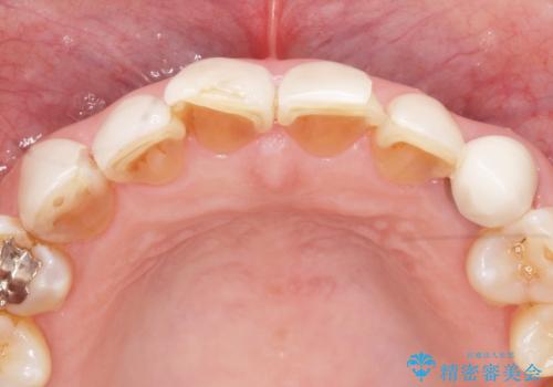 [ セラミック治療 ] 前歯の見た目を改善したいの治療前