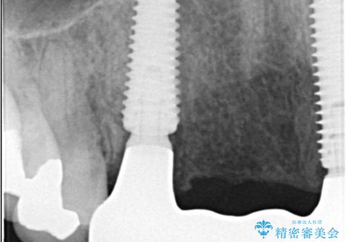 歯茎の腫れが気になる方必見!|抜歯即時インプラントで前歯5本を痛みなく3か月で治療完了!の治療後