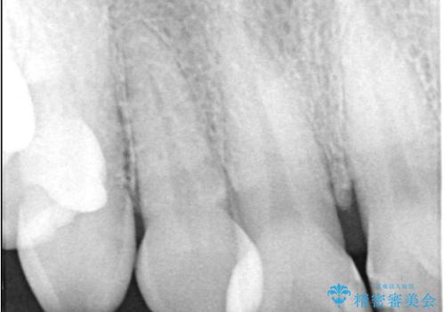 前歯の隙間とへこみが舌で触ると気になる|矯正治療は絶対にしたくない|抜歯即時インプラント+オールセラミッククラウンで審美修復の治療前