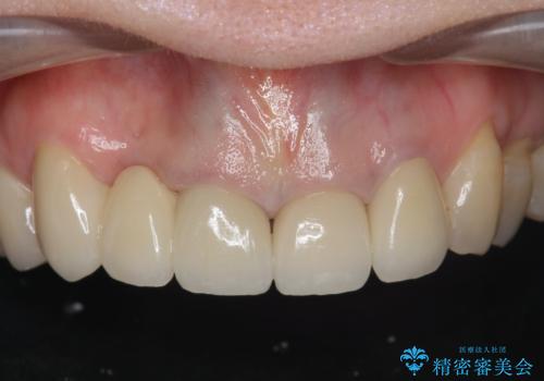 境目の見える前歯をきれいにしたい セラミック治療の症例 治療後