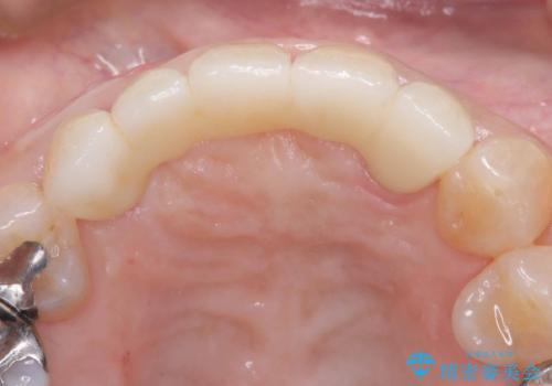 歯茎の腫れが気になる方必見!|抜歯即時インプラントで前歯5本を痛みなく3か月で治療完了!の治療後
