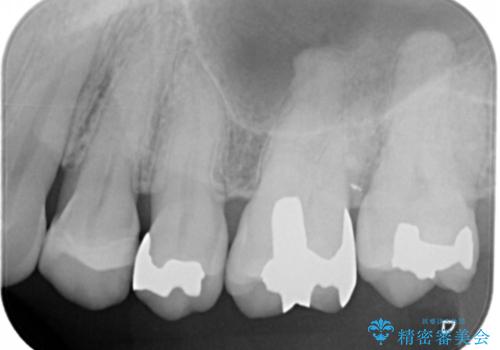 銀歯を白くしたい　セラミックインレーの治療前